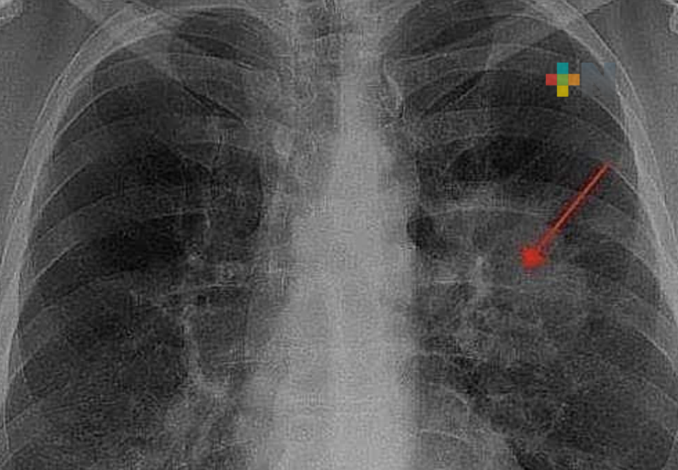 SS/Sesver invita a ciudadanía a informarse sobre los síntomas de cáncer de pulmón